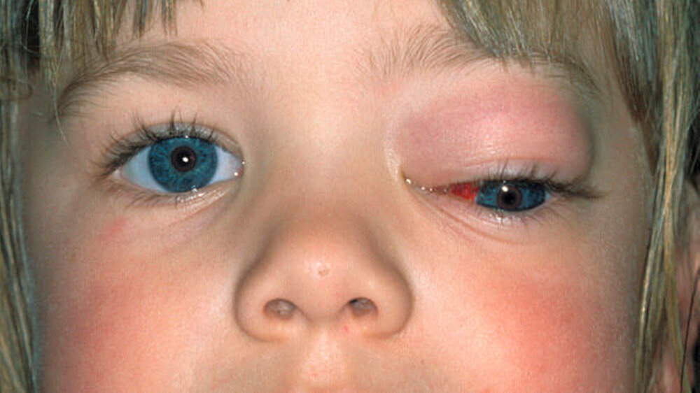 Ausgangsbefund der kleinen fünfjährigen Patientin.