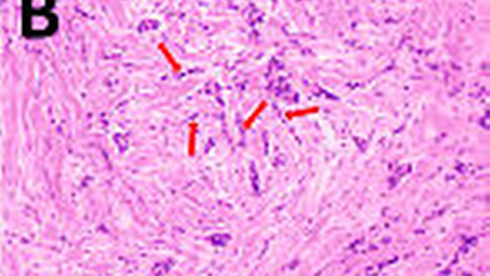 Abbildung 4: Knochenmetastase eines Mammakarzinoms mit teils glandulärem (a), teils verstreutzelligem Wachstum (b; rote Pfeile) und nukleärer Östrogenrezeptor-Positivität (c; intensive Braunfärbung der Zellkerne; rote Pfeile). (A und B: HE, C: immunhistochemische Färbung zum Nachweis nuklearer Östrogenrezeptoren) |