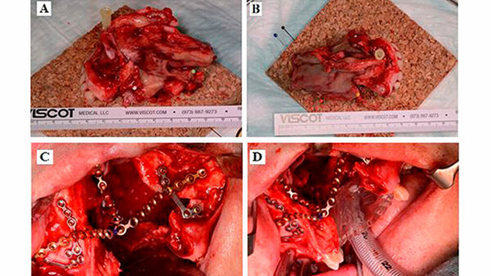 Abbildung 4: A = Tumorhauptpräparat bestehend aus Maxilla, Oberkieferfontzähnen 13-23, Nasenseptum und medialer Nasenmuschel, A in lateraler Ansicht, B = Tumor in Aufsicht, C = Operations-Situs mit Defekt in der Oberkieferfront und Stabilisierung mittel
