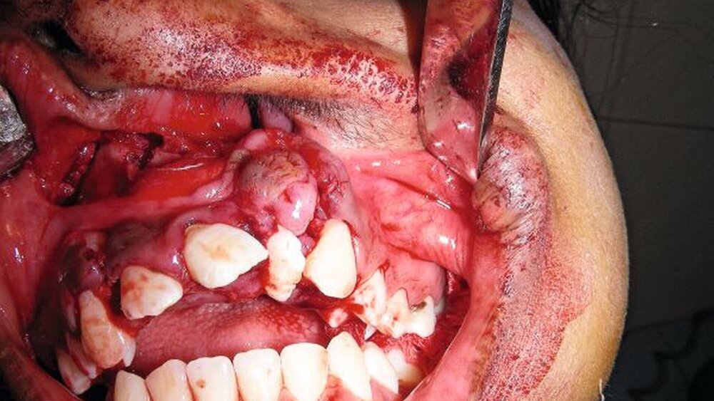 Abbildung 6: Operativer Situs nach Mobilisierung eines Segments vom knöchernen Nasenboden und Fixierung desselben mit den inkorporierten Zähnen im Bereich des Zahnbogens. |