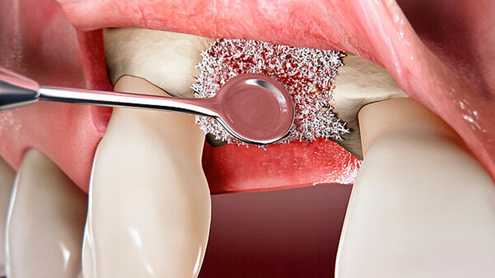 Abbildung 1: Insertionen eines Implantats in regio 12 – Ankörnung des Knochens, Schnittführung mit disto-vestibulärer Entlastung |