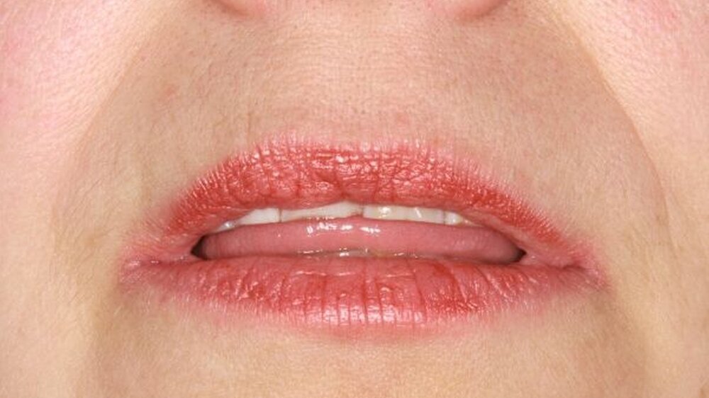 Abbildung 1: Deutlich verstärktes Oberflächenrelief der Lippen bei chronischer Xerostomie. |