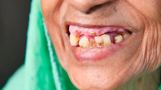 close up of senior women's dental caries and some broken teeth .