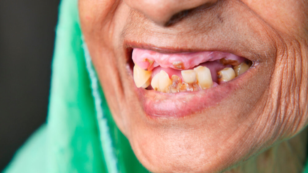 close up of senior women's dental caries and some broken teeth .