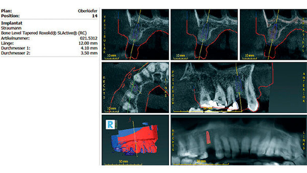 DVT-Darstellung der vollständigen Defektrekonstruktion regio 14 mit 3D-Implantatplanung (coDiagnostiX)