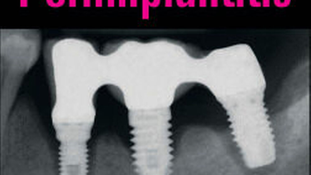 Stefan Renvert, Jean-Louis Giovannoli: Periimplantitis. 168 EUR |