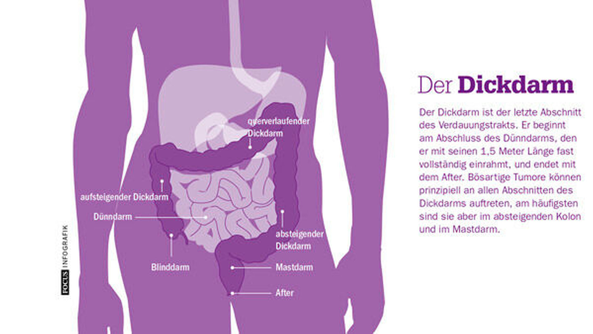 Dank Früherkennung Darmkrebs geht zurück