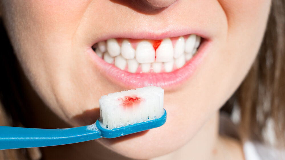 Woman with bleeding gums during teeth brushing. Hard toothbrush problem. Periodontal disease, avitaminosis, gingivitis, scurvy Woman with bleeding gums during teeth brushing. Hard toothbrush problem. Periodontal disease, avitaminosis, gingivitis, scurvy. High quality photo