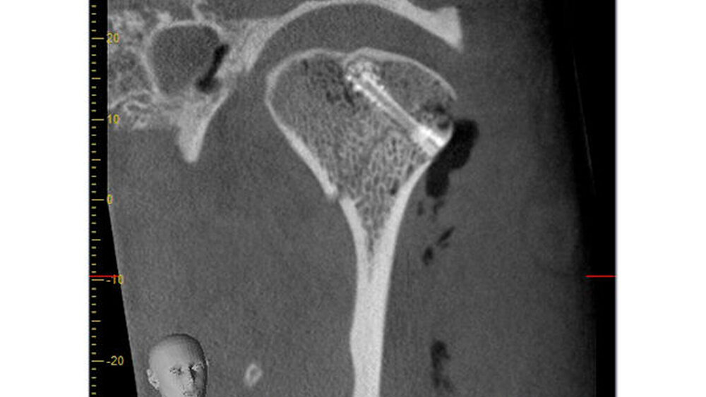 Abbildung 4: Das postoperative Digitale Volumentomogramm zeigt die gute Reponierung des Gelenkköpfchenfragments und die gute Platzierung der Schraube in der coronaren Ebene.
