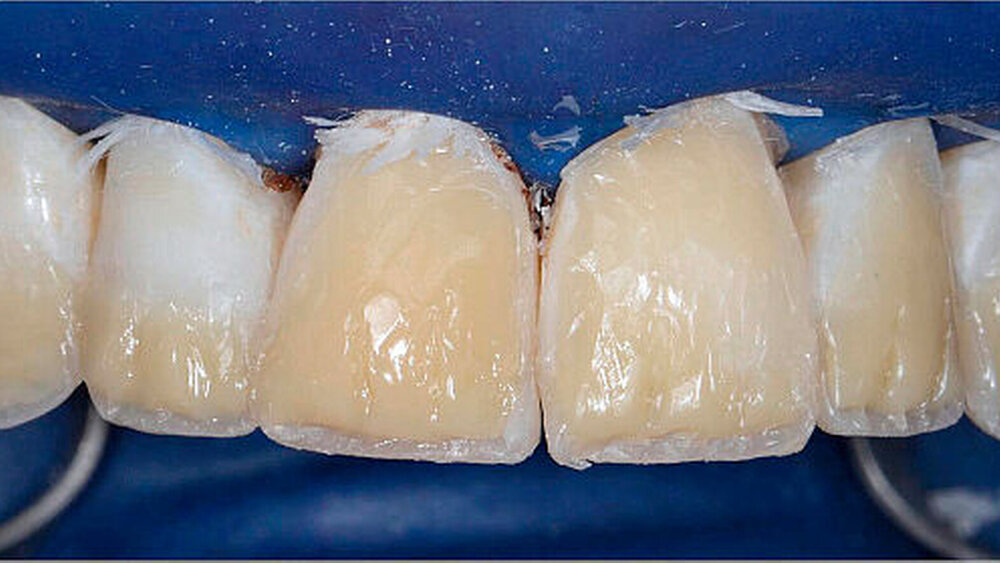 Abbildung 9: Eingebrachte Dentinmassen in Umrissform der Zähne |