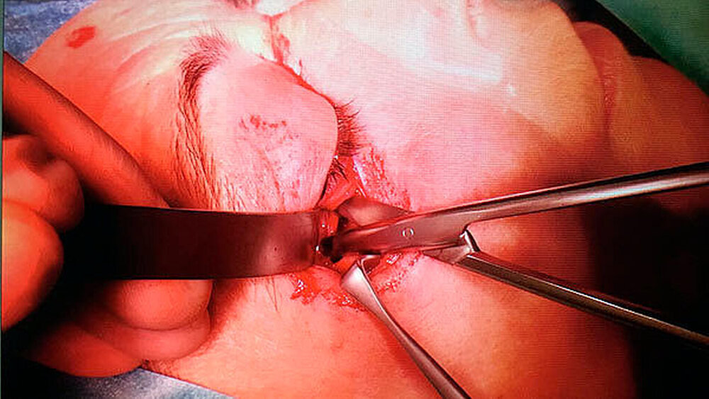 Abbildungen 4 und 5: Intraoperative Darstellung. Der Zugang zur Orbita erfolgte von subziliär durch das Septum orbitale. Nach Spreizen mit einer Schere entleerte sich massiv Pus. |