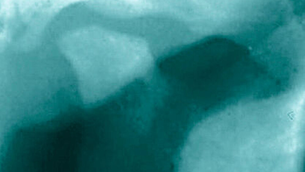 Abbildung 1 b: Größen- und Formveränderung des rechten Kondylus sowie abgeflachte Fossa, links ist der Kondylus unversehrt. |