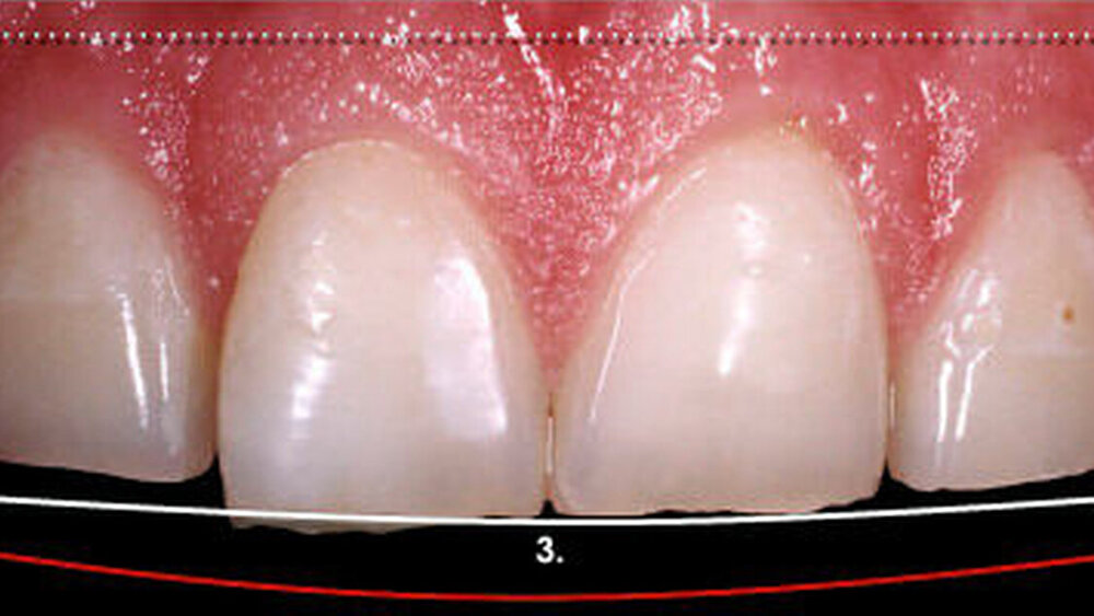 Abbildung 1: Die Frontzähne zeigen in der Ausgangssituation überwiegend abrasive Defekte mit einer geringfügigen erosiven Komponente. Zwei wichtige Hilfslinien sind beim Wax-up zu berücksichtigen: die Bipupillarlinie (1.) und die Unterlippenlinie beim Lächeln (2.). Von letzterer weicht die bestehende Zahnlänge (3.) deutlich ab. |