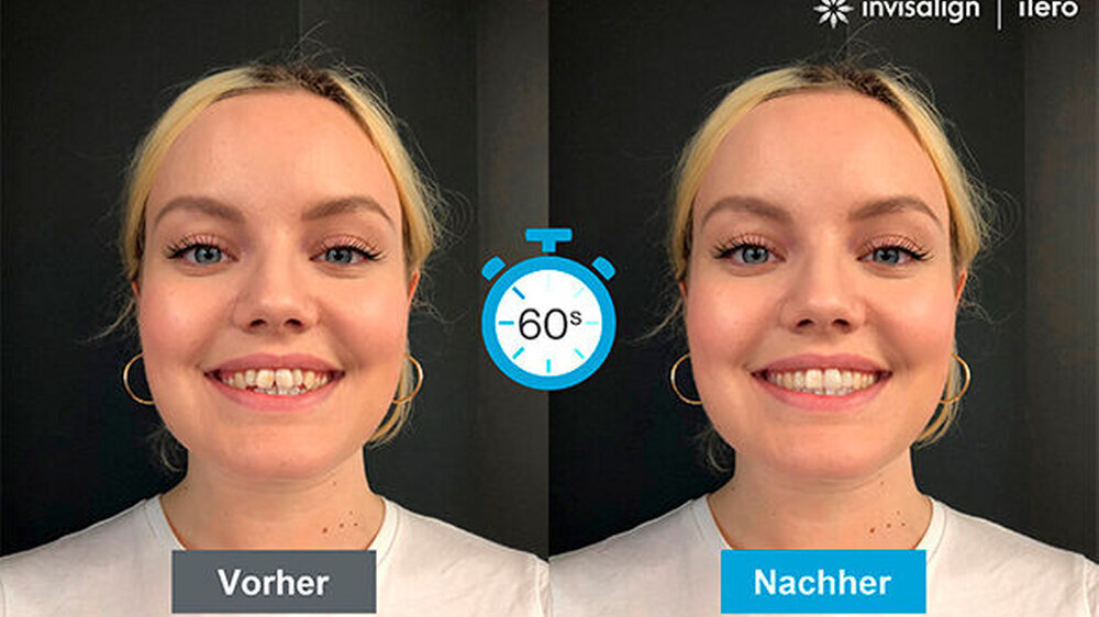 SmileView ist ein Online-Tool, das potentiellen Invisalign Patienten dabei helfen soll, ein neues und strahlenderes Lächeln zu visualisieren, noch bevor sie eine Invisalign Behandlung begonnen haben.