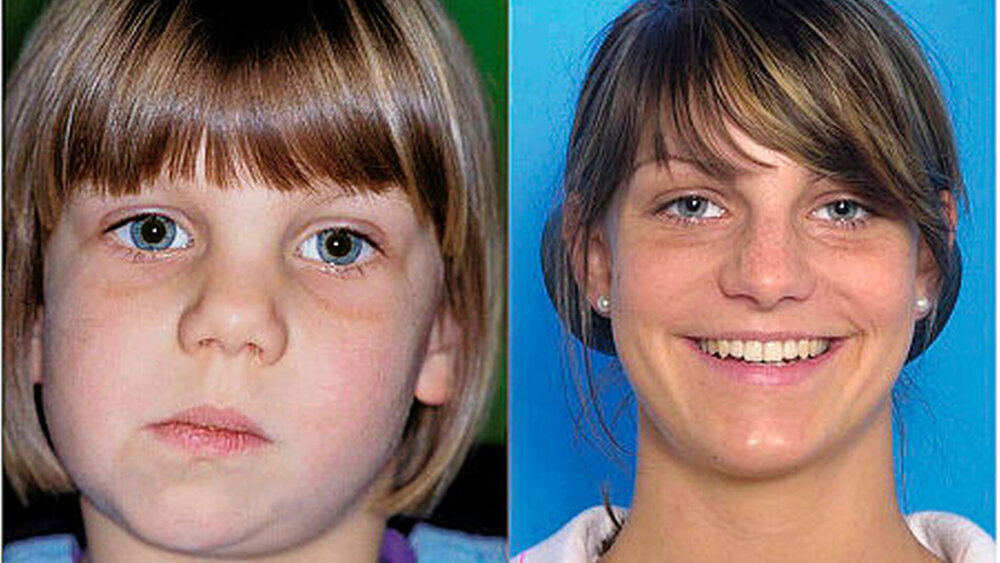 Abbildung 5a und b: en face Vergleich mit 5 Jahren prätherapeutisch und mit 17 Jahren nach Therapie- und Wachstumsabschluss bei o.g. Patientin mit hemifazialer Mikrosomie [Kahl-Nieke und Fischbach, 1998] |