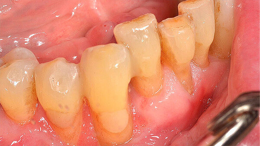 Abbildung 6: Postoperative Situation nach sechs Monaten |