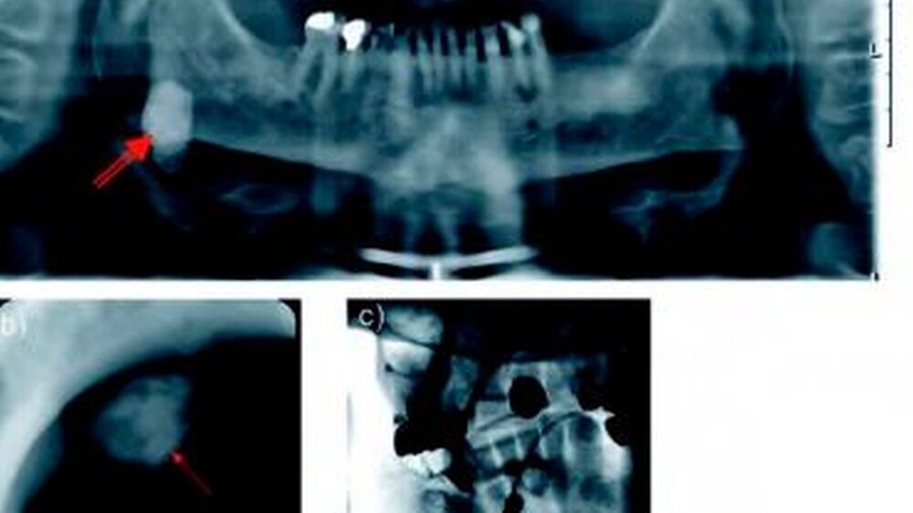 Abbildung 1: konventionelle Röntgenaufnahmen zur Diagnostik von Speichelsteinen:\r\na: OPG mit einer großen Verschattung im Sinne eines Speichelsteines der Glandula submandibularis rechts (roter Doppelpfeil)\r\nb: Unterkieferaufbissaufnahme mit zwei Ver