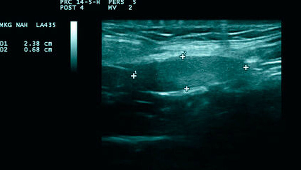 Abbildungen 2a und 2b: Ultraschall der Halsweichgewebe mit zum Teil deutlich vergrößerten Lymphknoten (a) in unmittelbarer Nachbarschaft zu den Gefäßen (b) markiert als oranges und blaues Areal |