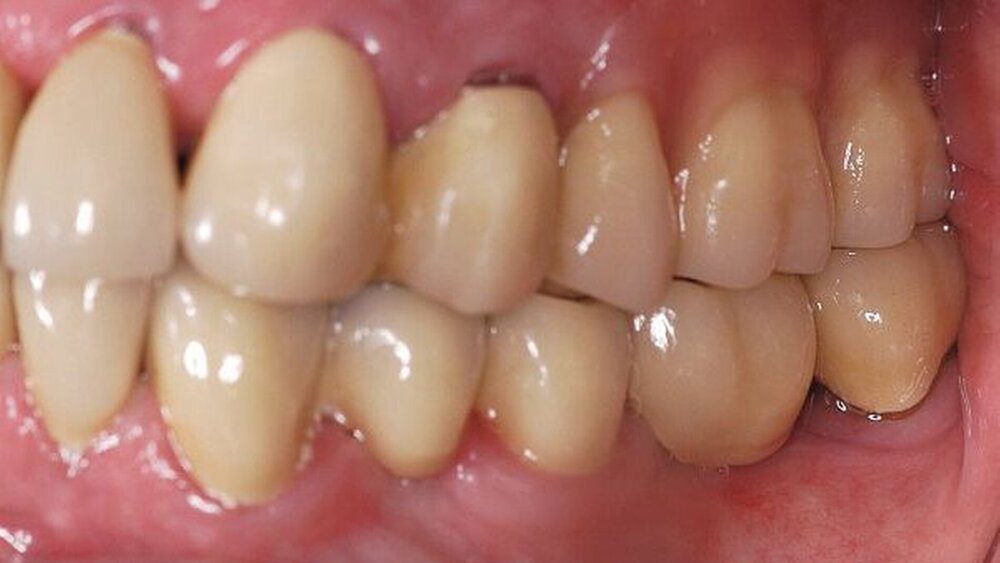 Abbildungen 16a, 16b, 16c, 16d, 16e: Abschlussbefund (definitiv befestigte Kronen und Brücken sowie eingegliederte partielle obere Prothese). |