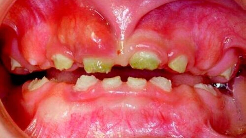 Abbildung 1a: Frontalansicht der Zähne eines 16 Monate alten Jungen:\r\ndeutlich erkennbare Schwellung der Schleimhaut und der Gingiva über dem rechten mittleren Schneidezahn, weiche Beläge am Zahnfleischrand sichtbar. Der paramarginale Zahnschmelz zei