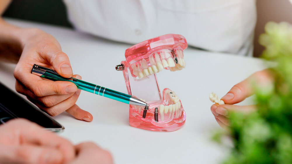 Zahnarzt zeigt dem Patienten die Technologie der Zahnimplantate am Kiefermodell.