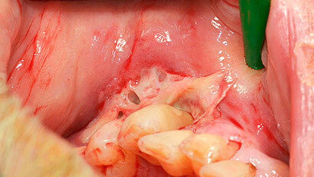 Abbildung 3: Klinischer Befund nach i.v.-Antibiose und Hygienisierung |