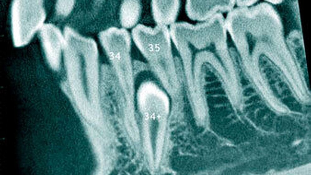 Abbildung 11: Überzähliger Zahn im Prämolarenbereich des linken Unterkiefers (34+) mit identischer Zahnform bei einem 23-jährigen Patienten (a: sagittales Schnittbild der digitalen Volumentomografie). |