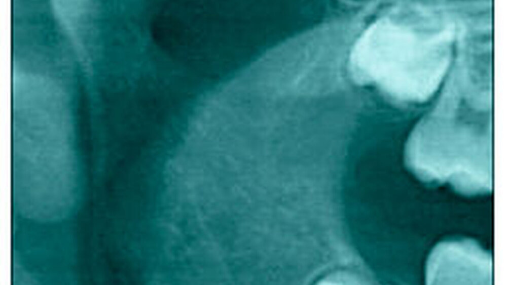 Abbildung 3b: Entrundungen mit unregelmäßiger Oberfläche |