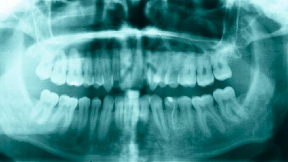 Abbildung 2: Das Orthopantomogramm zeigt die hyperplastischen Proc. coronoidei beidseits. |