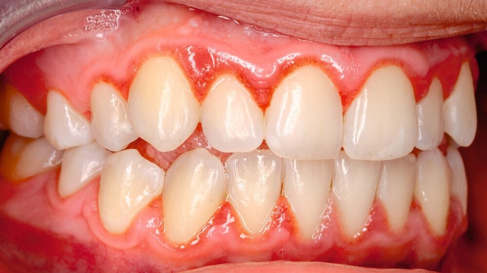teeth with gingivitis