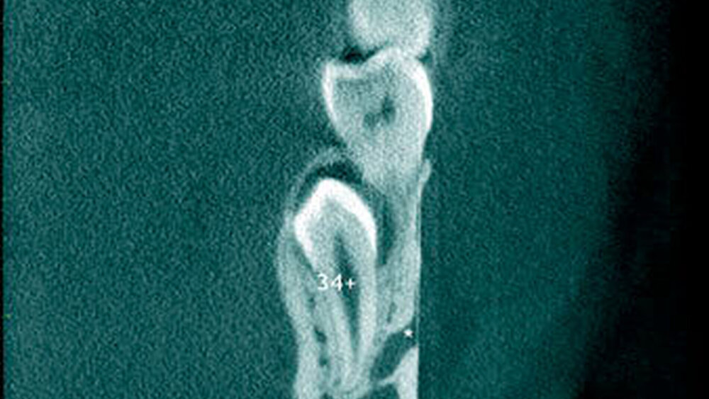 Abbildung 11: Überzähliger Zahn im Prämolarenbereich des linken Unterkiefers (34+) mit identischer Zahnform bei einem 23-jährigen Patienten (b: koronaler Schnitt). |