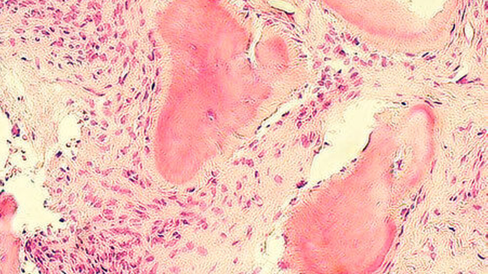 Abbildung 8: histologisches Präparat (HE-Färbung, Vergrößerung x200) (rechts). Hier zeigt sich ein fibröses, spindelzellhaltiges Stroma, in das einzelne Knochenbälkchen eingebettet sind. |