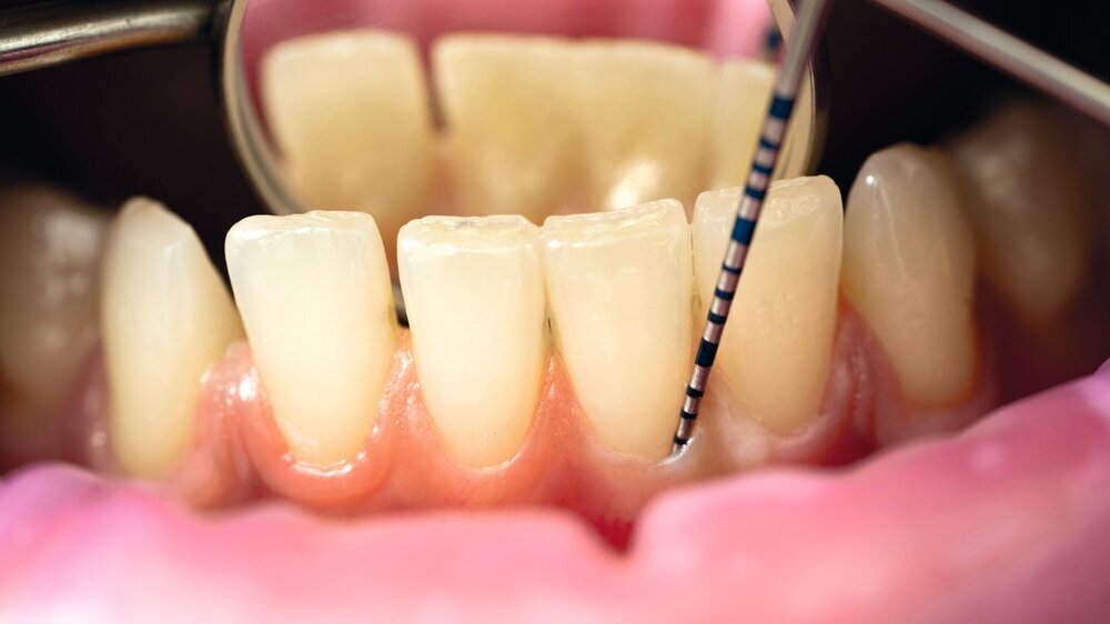 the dentist examines the depth of the patient's gums