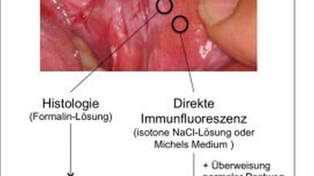 Abbildung 2: Konkretes diagnostisches Vorgehen: Es werden zwei Hautproben benötigt – eine läsionale Biopsie für die Histopathologie (links) und eine periläsionale Biopsie für die direkte Immunfluoreszenz (rechts). (*wie das Autoimmunlabor der Klinik für Dermatologie, Allergologie und Venerologie, UKSH, Campus Lübeck (www.derma.uni-luebeck.de/autoimmunlabor) |