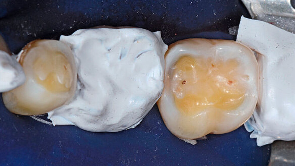 Abbildung 3: Isolation der Nachbarzähne der zu restaurierenden Zähne mit Teflonband zur Verhinderung eines interdentalen Verblockens |