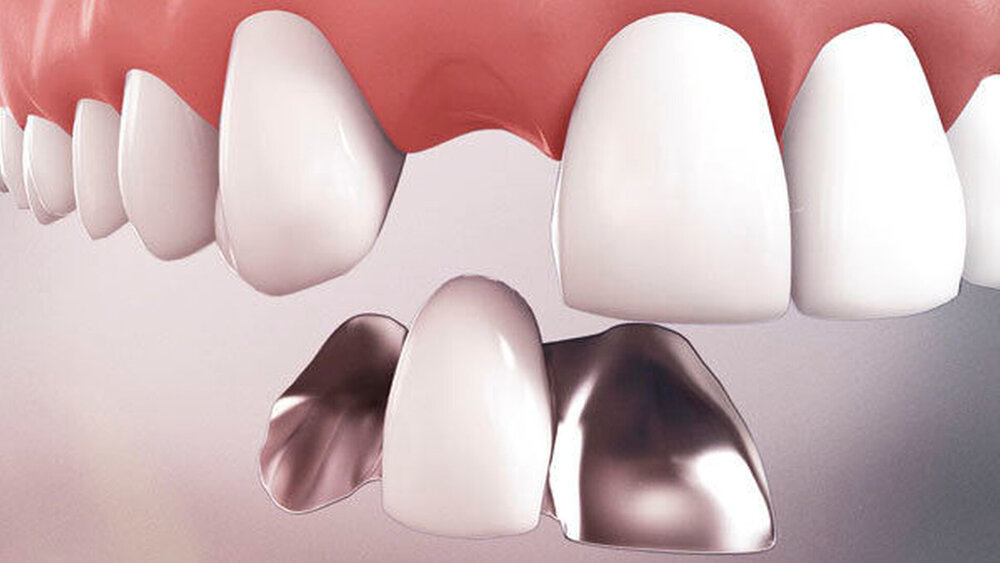 Die Adhäsivbrücke ist jetzt als zusätzliche Versorgungsalternative im Bema abgebildet. |