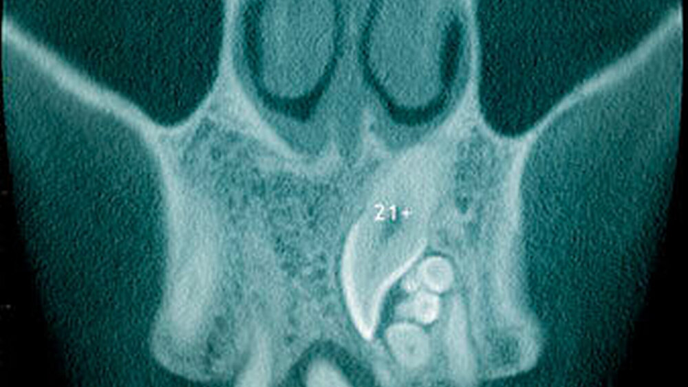 Abbildung 12: Überzähliger Zahn im Oberkieferfrontbereich (21+) mit einer konischen Form sowie ein zusammengesetztes Odontom disto-kaudal dieses überzähligen Zahnes bei einem 14-jährigen Knaben (a: koronales Schnittbild der digitalen Volumentomographie) |