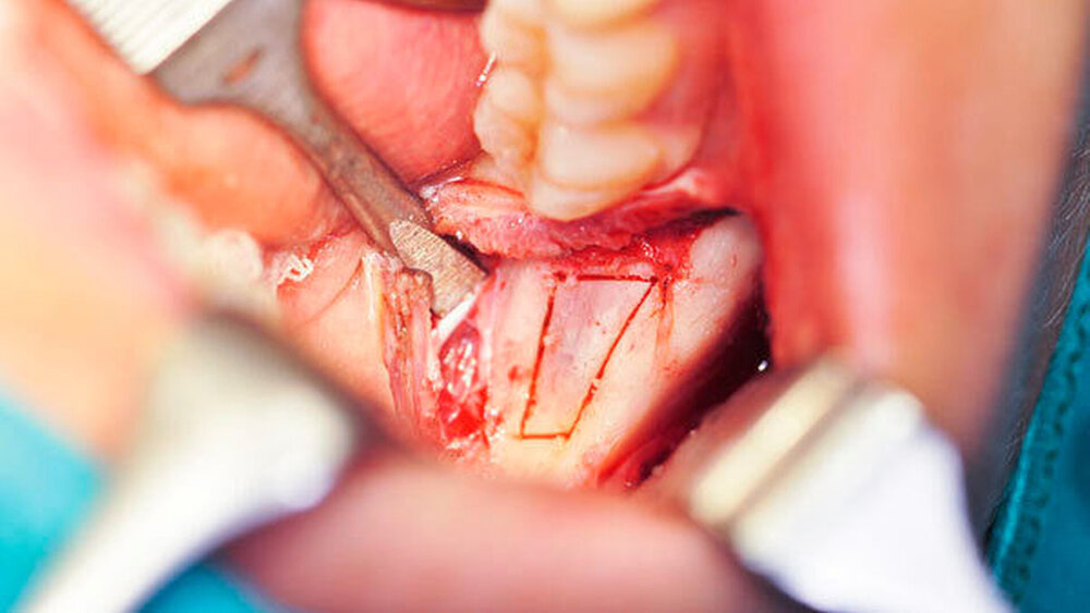 Abbildung 4: Piezochirurgische Osteotomie eines Knochendeckels krestal in regio 48. |
