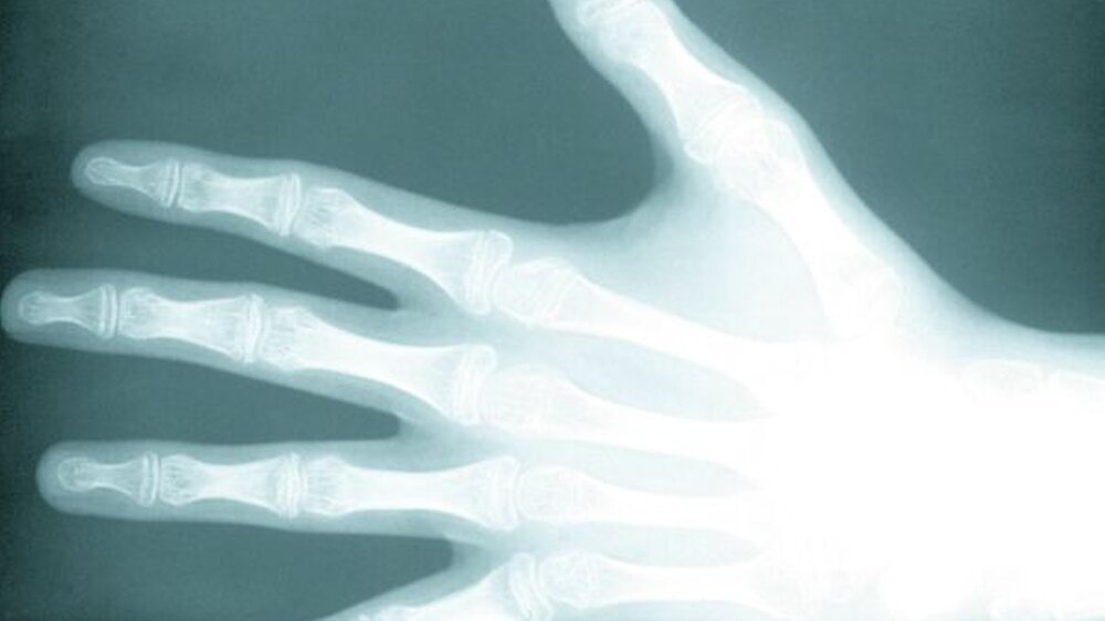 Das Röntgenbild dieser Hand zeigt eine typische Osteogenesis imperfecta, wie sie bei der Glasknochenkrankheit auftritt.