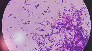 Hefepilzinfektion; Knospenhefe und Pseudohyphen von Candida albicans, Gram-Färbung.