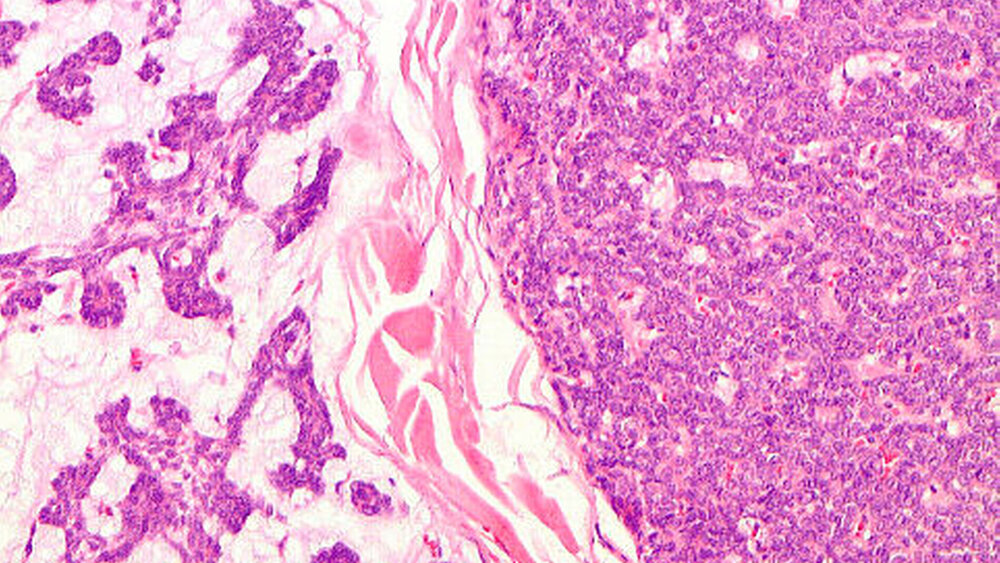 Abbildung 6: Zellreiches pleomorphes Adenom: Duktale Epithelzellen und Myoepithelien links in myxoidem Stroma, rechts: solide |