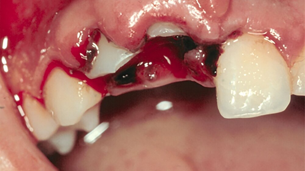 Abb. 2: Intrusionstrauma der Zähne 11 und 12. Man beachte die aufgetriebenen Alveolen und die Diskrepanz zwischen Gingiva und Zahnumfang. Abb. 2: Intrusionstrauma der Zähne 11 und 12. Man beachte die aufgetriebenen Alveolen und die Diskrepanz zwischen Gingiva und Zahnumfang.