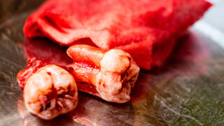 Freshly extracted molar wisdom tooth with blood stain placed on stainless stell container in dental clinic