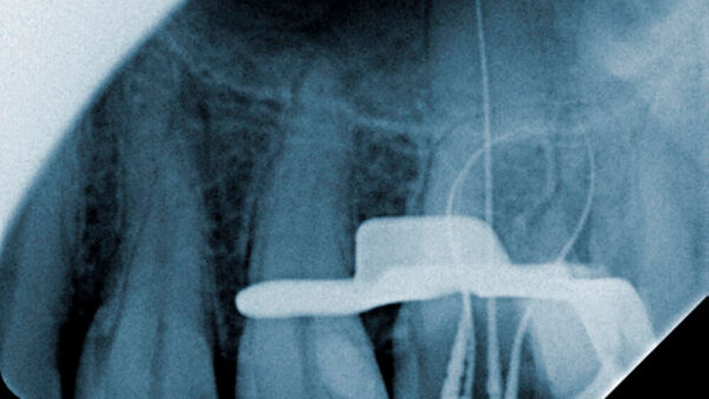 Abbildung 1: Auf der Messaufnahme ist die ausgeprägte Krümmung besonders der mesialen Wurzel nachvollziehbar. |