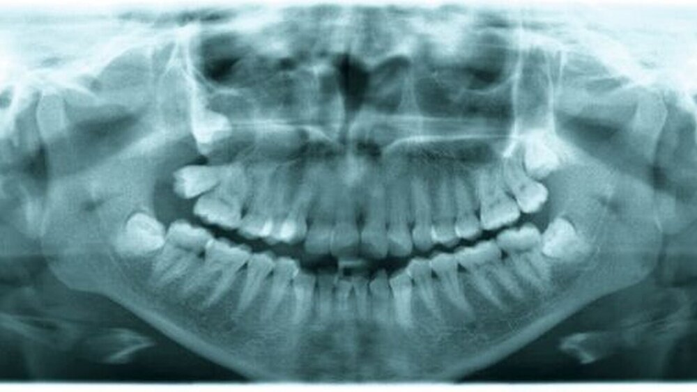 Abbildung 1: Präoperatives Orthopantomogramm mit Verschattung der rechten Kieferhöhle und dem in eine zystische Struktur eingebetteten, hochverlagerten Zahn 18. Der Zahn 17 kommt nach distal gekippt zur Darstellung. |