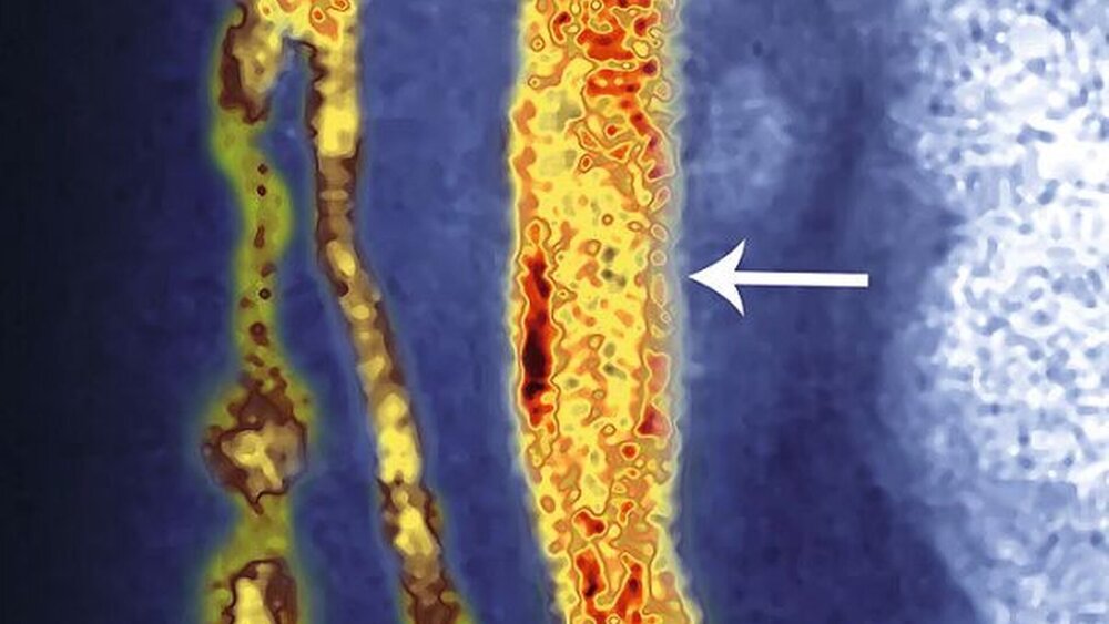 Auf der angiografischen Aufnahme ist der Thrombus deutlich sichtbar. |