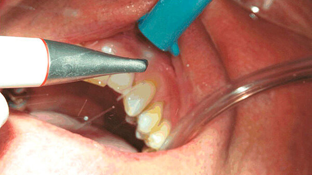 Prophylaxe mit Air-Flow Handstück. |