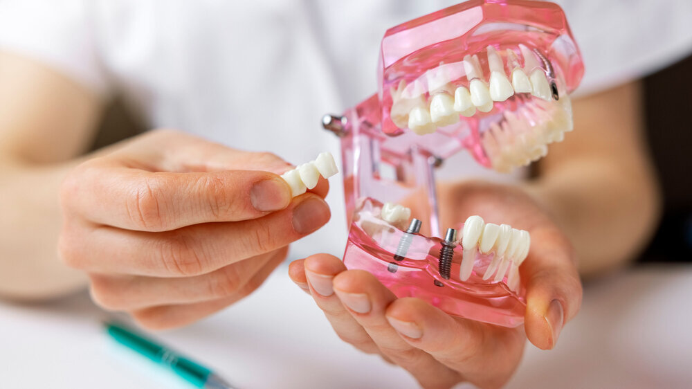 dentist implantologist showing dental bridge implant technology on human tooth jaw model dentist implantologist showing dental bridge implant technology on human tooth jaw model