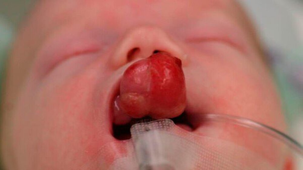 Abbildung 2: frontale Ansicht des exophytisch wachsenden Haupttumors