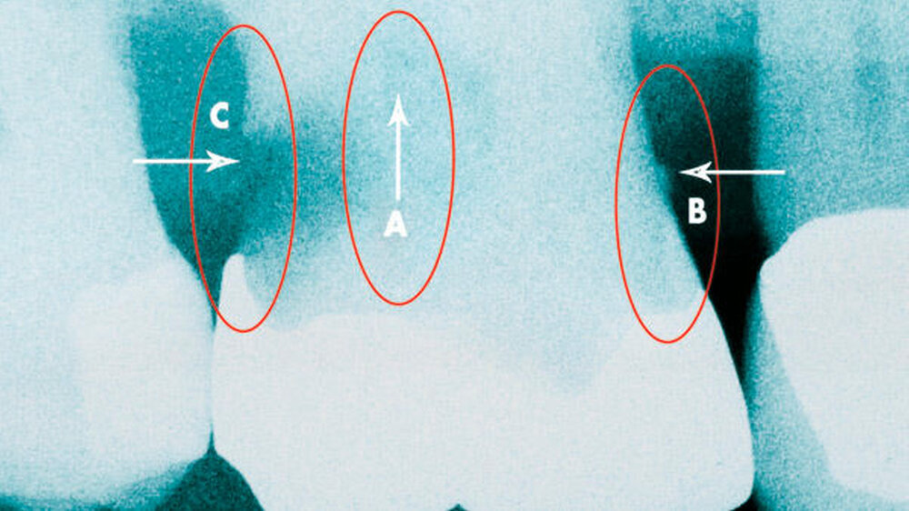 Abbildung 1: Darstellung für potenzielle endodontische (A), parodontale (B) oder restaurative (C) \r\nInterventionen: Situation A: Im Fall einer endodontischen Intervention Klassifikation nach RKI: semikritisch/kritisch Handschuhe: nicht steril Kühlung Abbildung 1: Darstellung für potenzielle endodontische (A), parodontale (B) oder restaurative (C) Interventionen: Situation A: Im Fall einer endodontischen Intervention Klassifikation nach RKI: semikritisch/kritisch Handschuhe: nicht steril Kühlung Wasserqualität: Betriebswasser aus der Dentaleinheit Kavitätenverschluss: ja Situation B: Im Fall einer parodontalen Intervention (hier: Geschlossene Kürettage) Klassifikation nach RKI: semikritisch/kritisch Handschuhe: nicht steril Kühlung Wasserqualität: Betriebswasser aus der Dentaleinheit Wundverschluss: nein Situation C: Im Fall einer restaurativen Intervention (hier: subgingivale Kariestherapie) Klassifikation nach RKI: semikritisch/kritisch Handschuhe: nicht steril Kühlung Wasserqualität: Betriebswasser aus der Dentaleinheit Wundverschluss: nein